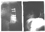 Xray of curve; Before 98 degree and after 45 degree