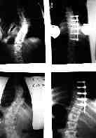 Xray of before and after correction